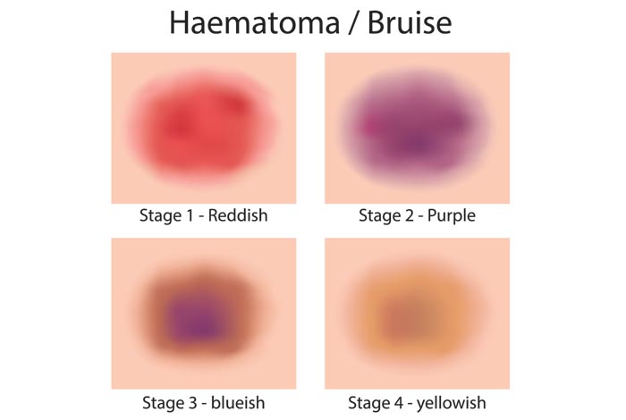 bruise stages and colors